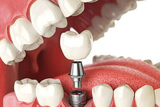 Cirugía e Implantes Dentales